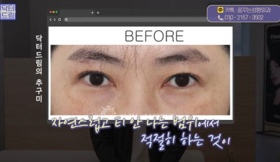 [닥터드림]눈밑지방재배치 하러왔다가 더 비싼 하안검한 사연 사진 23