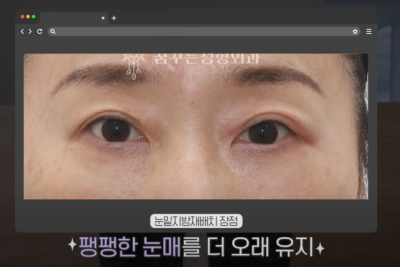 [닥터드림]눈밑지방재배치 하러왔다가 더 비싼 하안검한 사연 사진 8