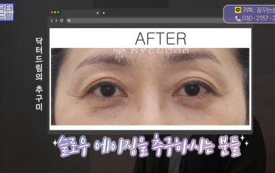 [닥터드림]눈밑지방재배치 하러왔다가 더 비싼 하안검한 사연 사진 20