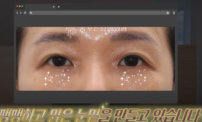 [닥터드림]눈밑지방재배치 하러왔다가 더 비싼 하안검한 사연 사진 4