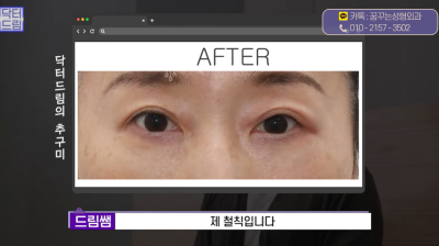 [닥터드림]눈밑지방재배치 하러왔다가 더 비싼 하안검한 사연 사진 22