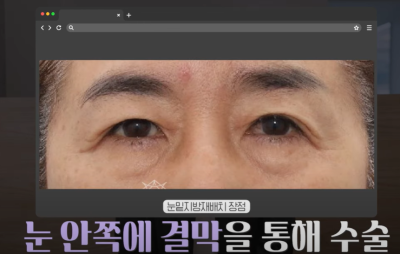[닥터드림]눈밑지방재배치 하러왔다가 더 비싼 하안검한 사연 사진 5