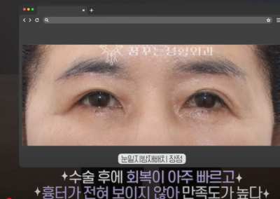 [닥터드림]눈밑지방재배치 하러왔다가 더 비싼 하안검한 사연 사진 6