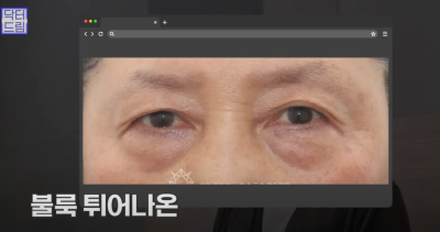 [닥터드림]눈밑지방재배치 하러왔다가 더 비싼 하안검한 사연 사진 13