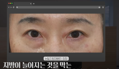 [닥터드림]눈밑지방재배치 하러왔다가 더 비싼 하안검한 사연 사진 7