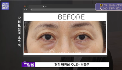 [닥터드림]눈밑지방재배치 하러왔다가 더 비싼 하안검한 사연 사진 19