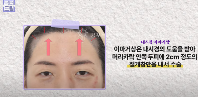 요즘 쌍꺼풀 안하는 상상초월 이유/ 쌍꺼풀 대신 이거합니다 사진 7