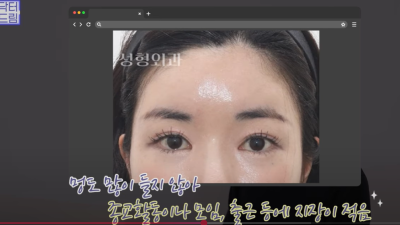 요즘 쌍꺼풀 안하는 상상초월 이유/ 쌍꺼풀 대신 이거합니다