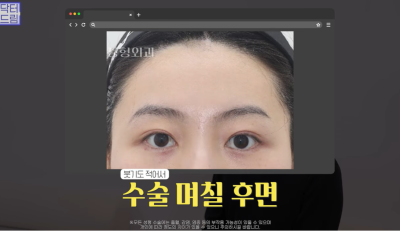 요즘 쌍꺼풀 안하는 상상초월 이유/ 쌍꺼풀 대신 이거합니다 사진 10