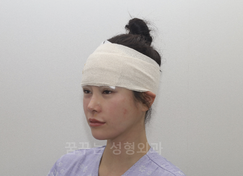 강남 이마거상 8일차 후기, 일본 모델 아야의 고민– 2-30대 이마주름 사진 6