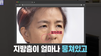 레이저 아플수록 효과가 좋을까요? 사진 9
