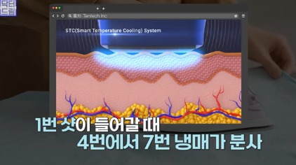 레이저 아플수록 효과가 좋을까요? 사진 17