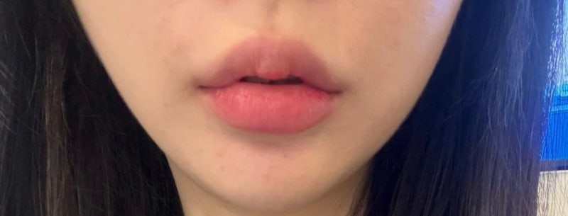 강남역 입술필러 장인을 찾는다면? = 꿈꾸는 성형외과! 💋✨ 사진 8