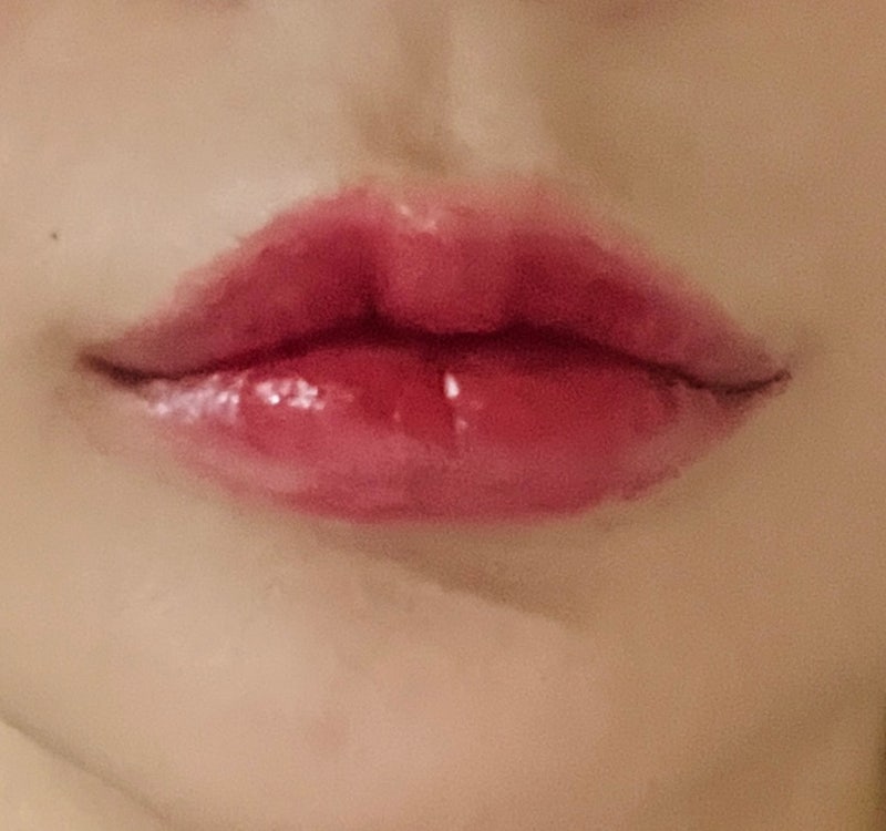 강남역 입술필러 장인을 찾는다면? = 꿈꾸는 성형외과! 💋✨ 사진 9