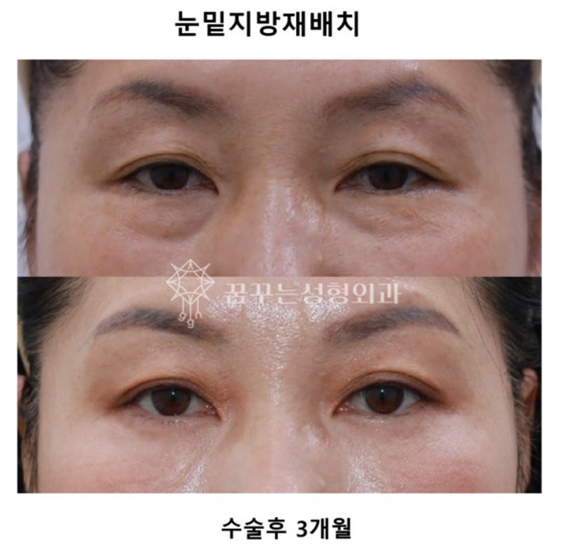 💐 5월 가정의 달, 부모님께 드리는 특별한 효도 선물– 이마거상 / 리프팅 / 상안검 / 하안검 / 눈밑지방재배치 추천 – 사진 9
