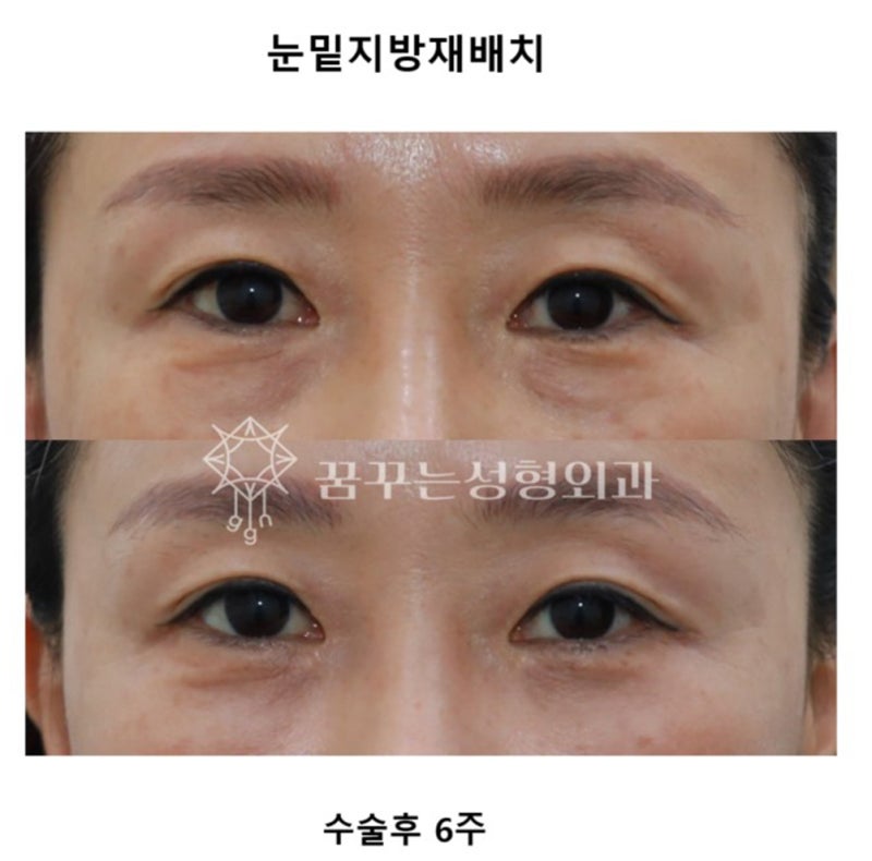 💐 5월 가정의 달, 부모님께 드리는 특별한 효도 선물– 이마거상 / 리프팅 / 상안검 / 하안검 / 눈밑지방재배치 추천 – 사진 8