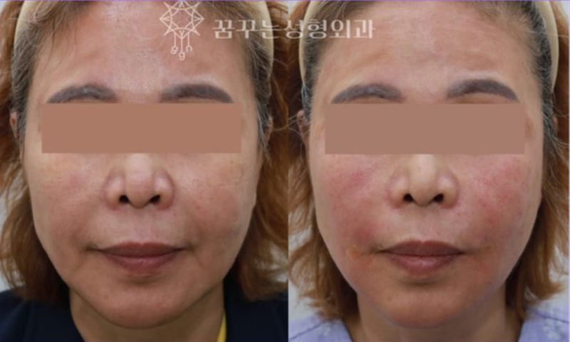 💐 5월 가정의 달, 부모님께 드리는 특별한 효도 선물– 이마거상 / 리프팅 / 상안검 / 하안검 / 눈밑지방재배치 추천 –