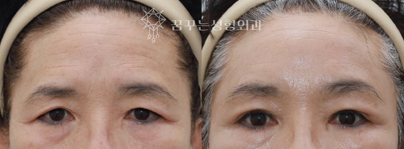 💐 5월 가정의 달, 부모님께 드리는 특별한 효도 선물– 이마거상 / 리프팅 / 상안검 / 하안검 / 눈밑지방재배치 추천 –