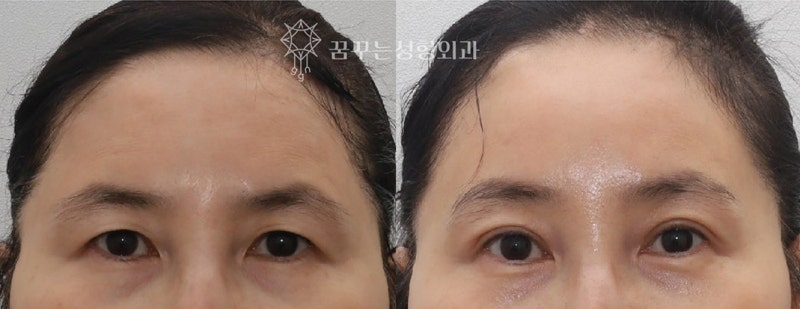 💐 5월 가정의 달, 부모님께 드리는 특별한 효도 선물– 이마거상 / 리프팅 / 상안검 / 하안검 / 눈밑지방재배치 추천 – 사진 2