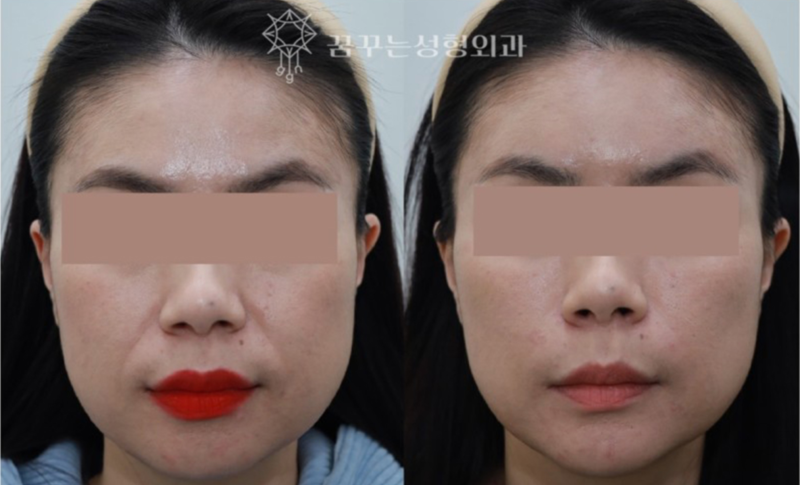 💡 지방이식과 필러, 어떤 차이가 있을까요? 강남역 성형외과