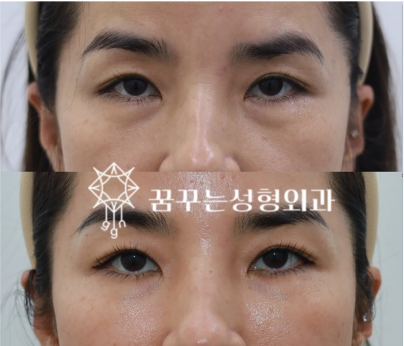 💡 지방이식과 필러, 어떤 차이가 있을까요? 강남역 성형외과 사진 6