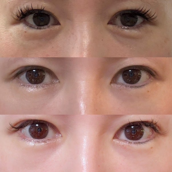 강남역 눈밑지방재배치 잘하는 곳 수술 후기✨ (꿈꾸는 성형외과)