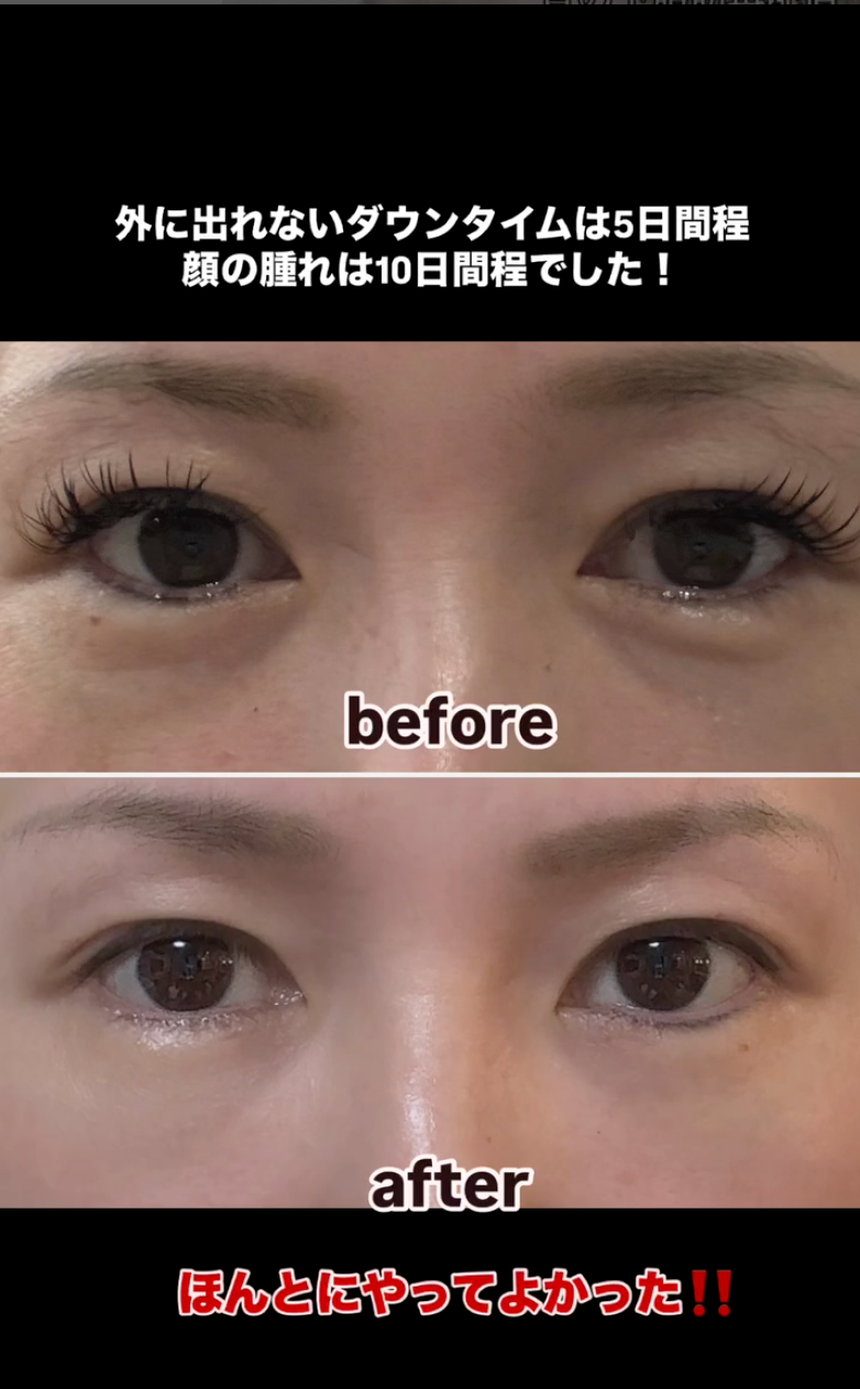 강남역 눈밑지방재배치 잘하는 곳 수술 후기✨ (꿈꾸는 성형외과) 사진 9