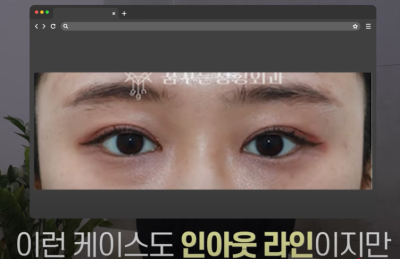 [연예인쌍꺼풀 공식] 나에게 어울리는 쌍꺼풀 찾기 사진 20