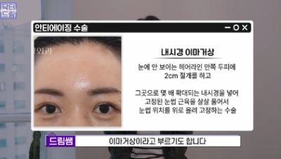 남편도 모르는 티안나는 극강의효과 동안성형 이마거상 사진 8