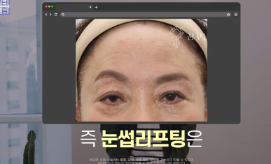 남편도 모르는 티안나는 극강의효과 동안성형 이마거상 사진 14