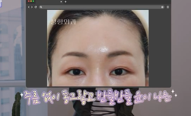 남편도 모르는 티안나는 극강의효과 동안성형 이마거상 사진 24