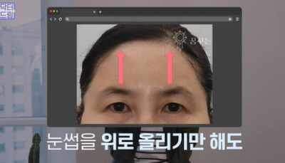 남편도 모르는 티안나는 극강의효과 동안성형 이마거상 사진 16