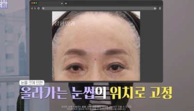 남편도 모르는 티안나는 극강의효과 동안성형 이마거상 사진 15