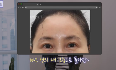 남편도 모르는 티안나는 극강의효과 동안성형 이마거상 사진 17