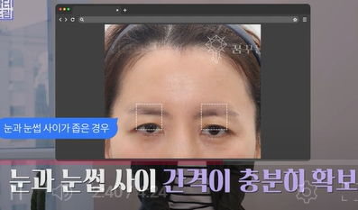 남편도 모르는 티안나는 극강의효과 동안성형 이마거상 사진 21
