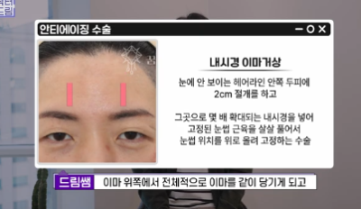 남편도 모르는 티안나는 극강의효과 동안성형 이마거상 사진 7