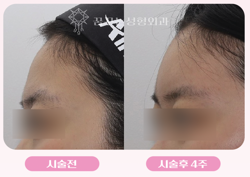 강남역 이마필러 추천! 아직도 앞머리로 이마 가리시나요? 볼륨있는 이마로 동안 만들기 사진 6