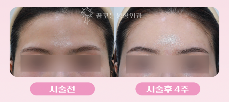강남역 이마필러 추천! 아직도 앞머리로 이마 가리시나요? 볼륨있는 이마로 동안 만들기 사진 5