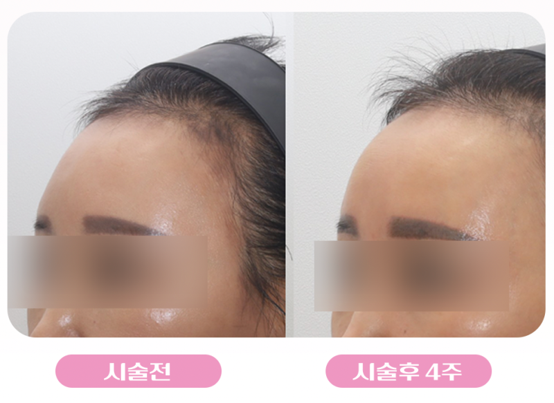 강남역 이마필러 추천! 아직도 앞머리로 이마 가리시나요? 볼륨있는 이마로 동안 만들기 사진 8