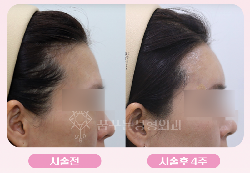 강남역 이마필러 추천! 아직도 앞머리로 이마 가리시나요? 볼륨있는 이마로 동안 만들기