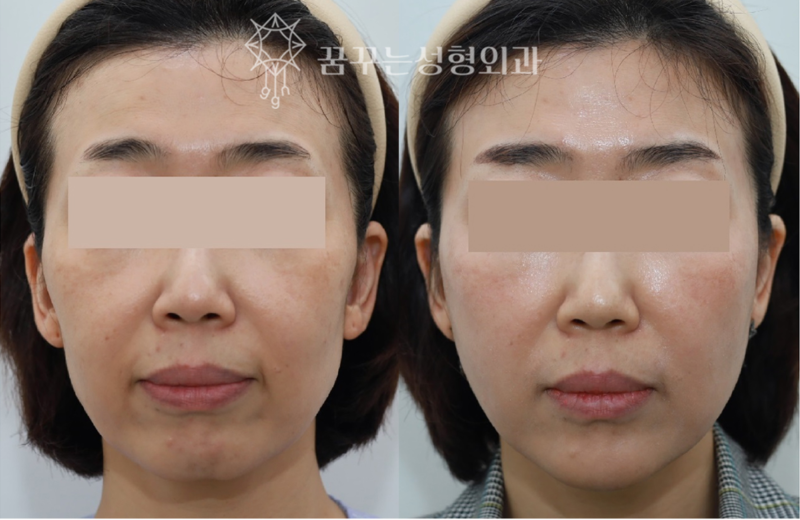강남 중년 안티에이징, 우아하게 나이들고 싶다면