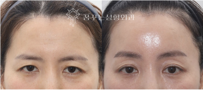 강남 중년 안티에이징, 우아하게 나이들고 싶다면 사진 15