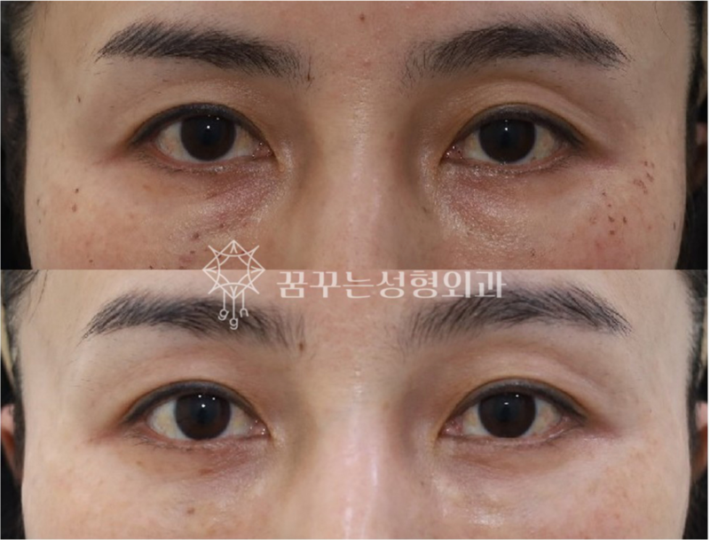 강남 상안검 잘하는 곳, 눈두덩이 쑥 꺼지고 퀭한 눈이 고민이라면 사진 9