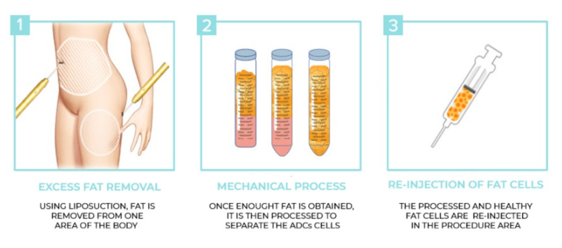 강남 상안검 잘하는 곳, 눈두덩이 쑥 꺼지고 퀭한 눈이 고민이라면 사진 8