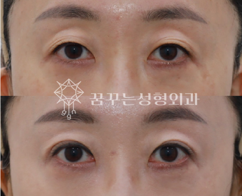 강남 상안검 잘하는 곳, 눈두덩이 쑥 꺼지고 퀭한 눈이 고민이라면 사진 3