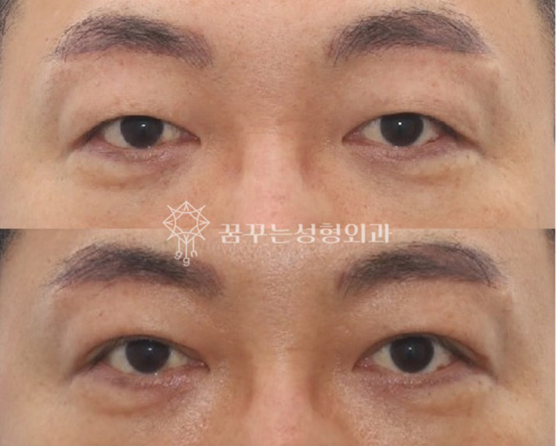 강남 상안검 잘하는 곳, 눈두덩이 쑥 꺼지고 퀭한 눈이 고민이라면 사진 7