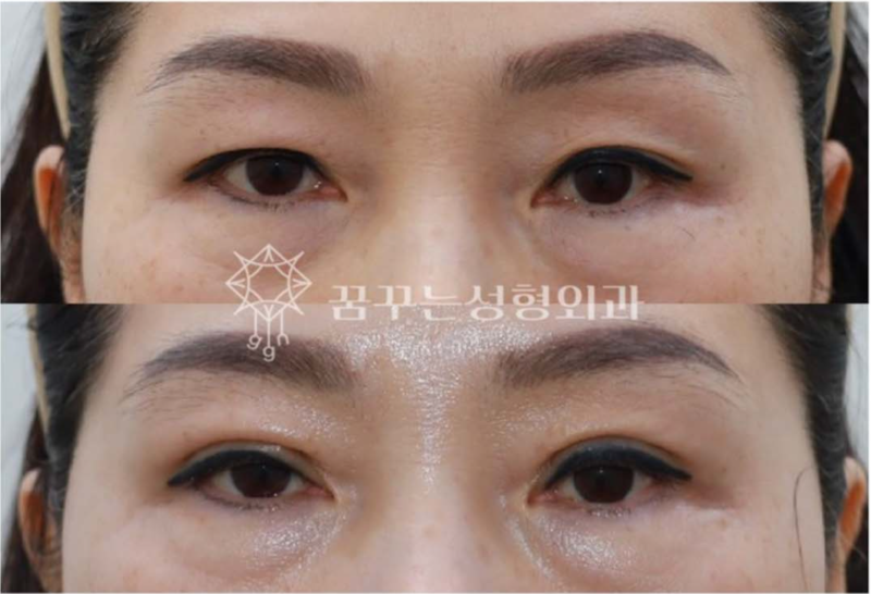 강남 상안검 잘하는 곳, 눈두덩이 쑥 꺼지고 퀭한 눈이 고민이라면