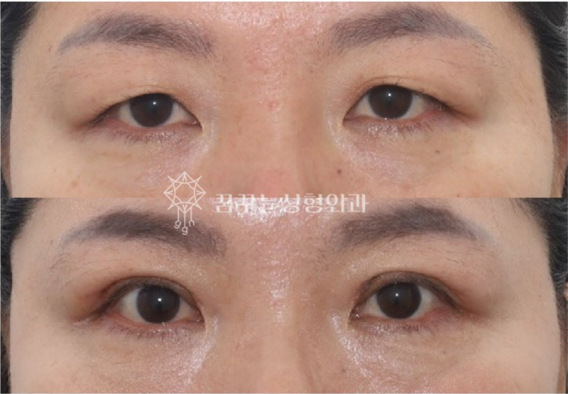 강남 상안검 잘하는 곳, 눈두덩이 쑥 꺼지고 퀭한 눈이 고민이라면 사진 12