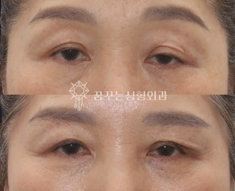 강남 상안검 잘하는 곳, 눈두덩이 쑥 꺼지고 퀭한 눈이 고민이라면 사진 6