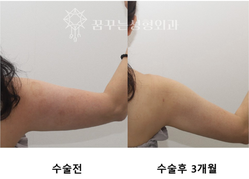 강남역 다이어트 지방흡입 이중턱, 승모근, 종아리보톡스 사진 4